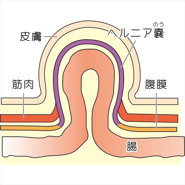 鼠径ヘルニア