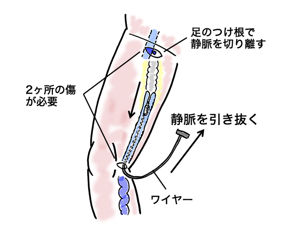 ストリッピング手術