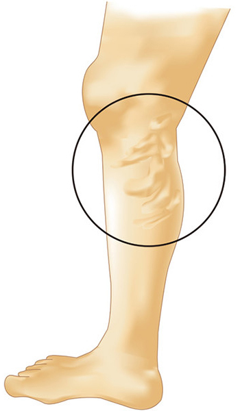 下肢静脈瘤のタイプ