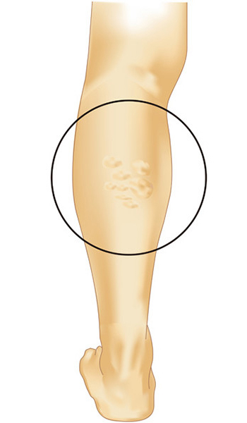 下肢静脈瘤のタイプ
