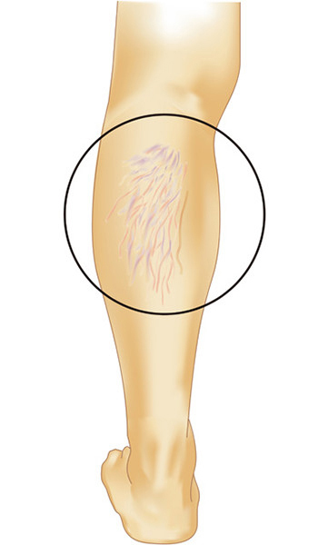 下肢静脈瘤のタイプ