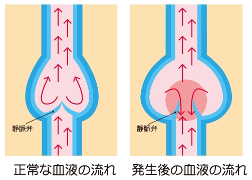 下肢静脈瘤